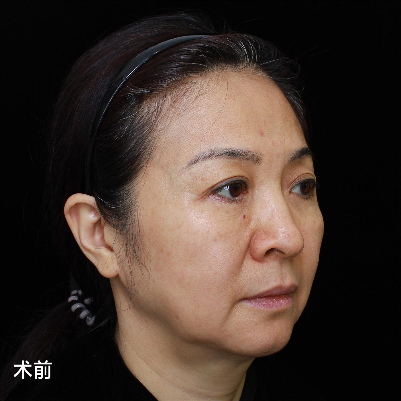 拉皮术后真实记录,52岁居然活成了这个样子 拉皮术后真实记录,52岁居然活成了这个样子