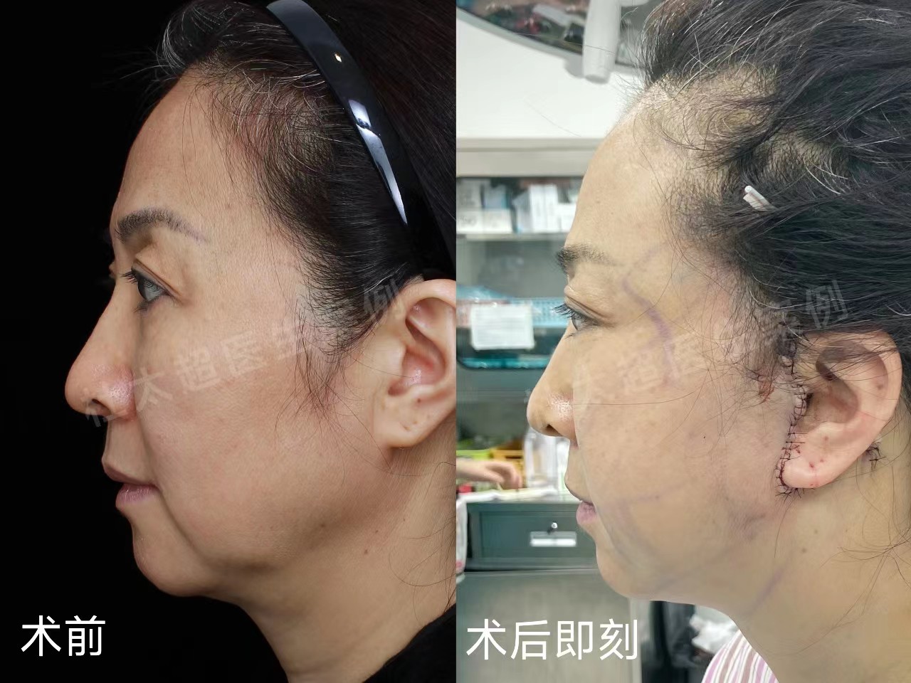 拉皮术后真实记录,52岁居然活成了这个样子 拉皮术后真实记录,52岁居然活成了这个样子