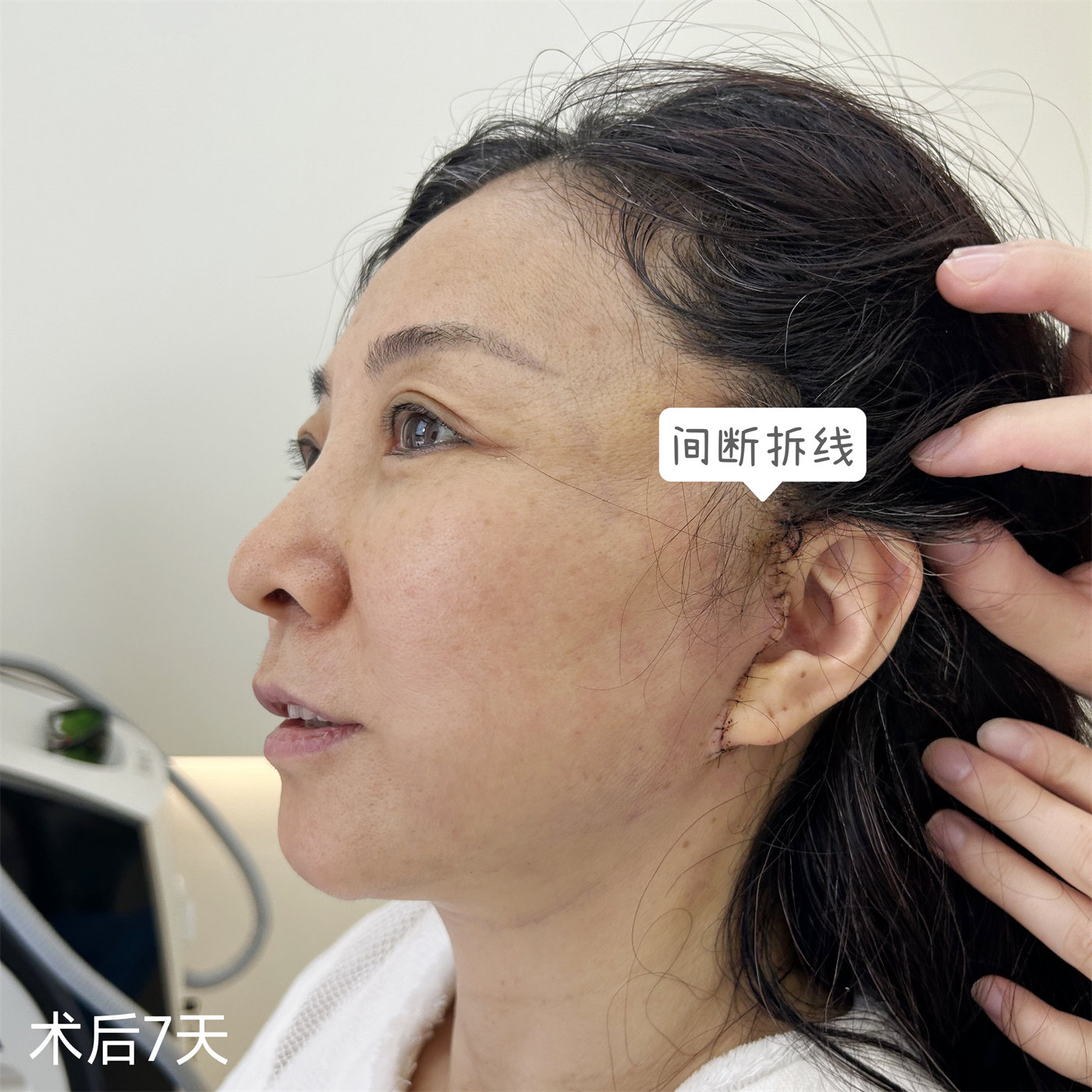 拉皮术后真实记录,52岁居然活成了这个样子 拉皮术后真实记录,52岁居然活成了这个样子