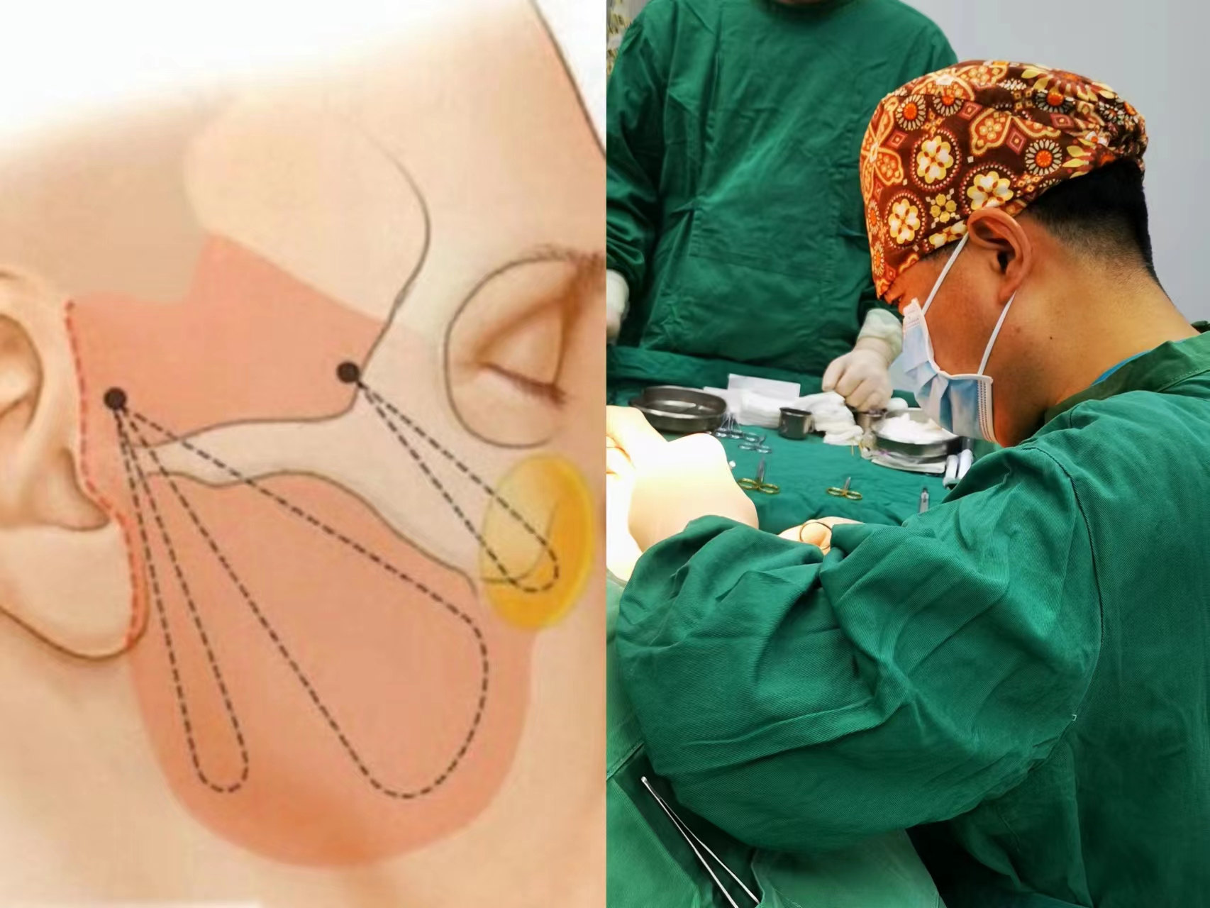 为什么很多“线雕粉”最后都倒戈“拉皮手术”? 为什么很多“线雕粉”最后都倒戈“拉皮手术”?