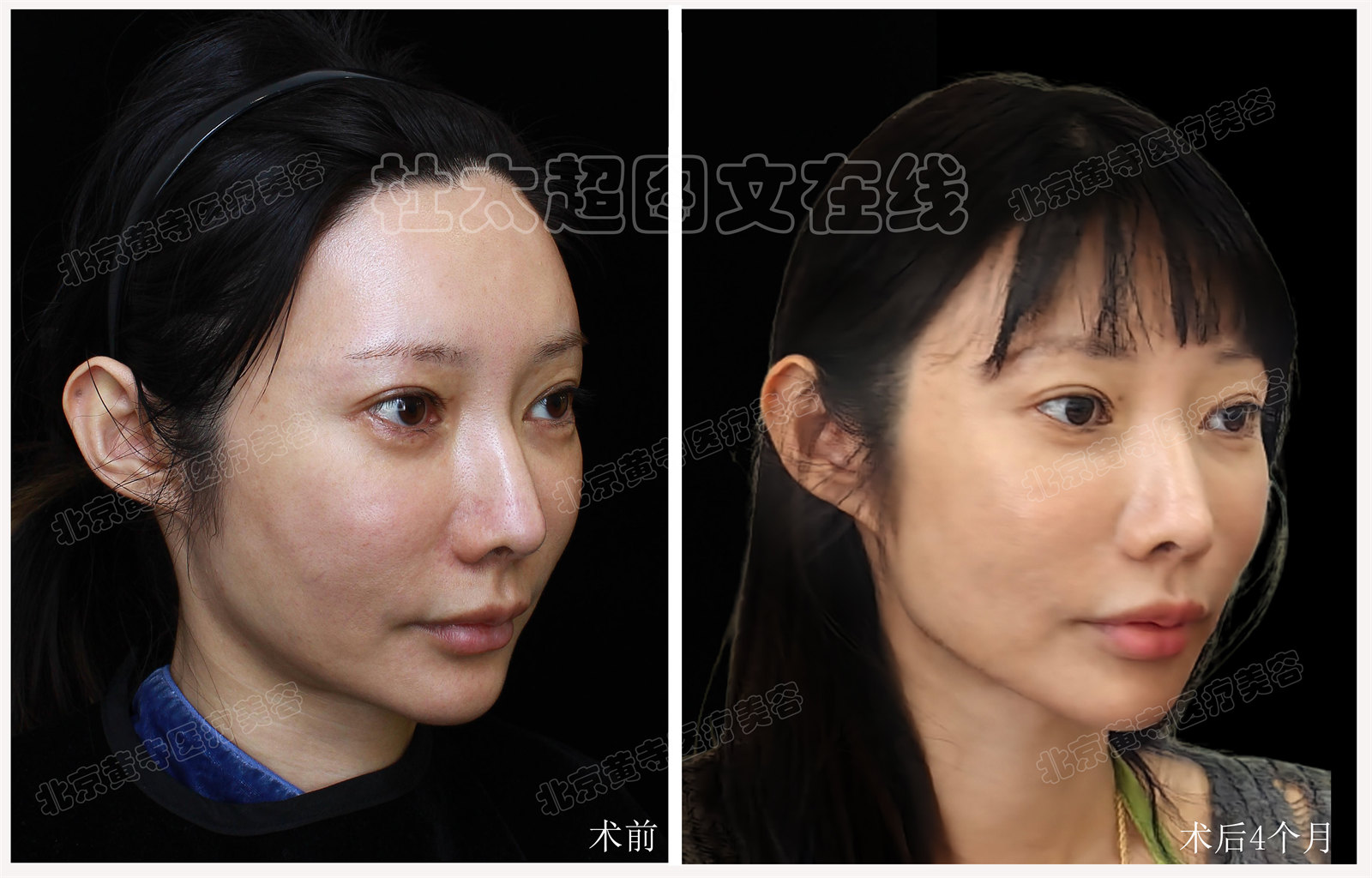 拉皮面部提升术后近期随访4个月