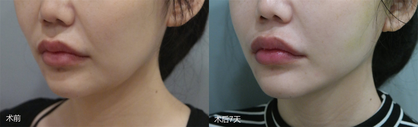 下颌缘松弛下垂怎么办？不同起因不同的治疗方案