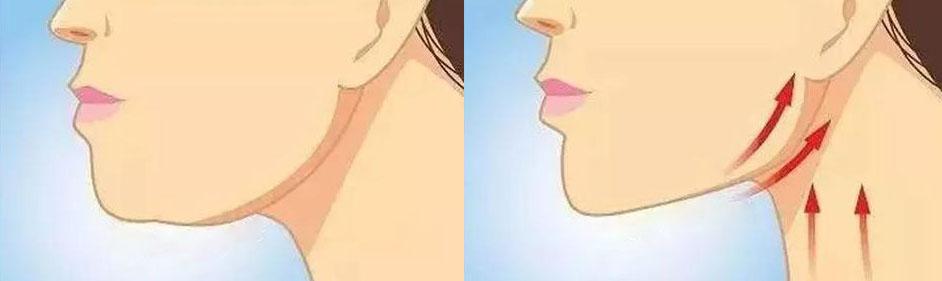 下颌缘松弛下垂怎么办？不同起因不同的治疗方案