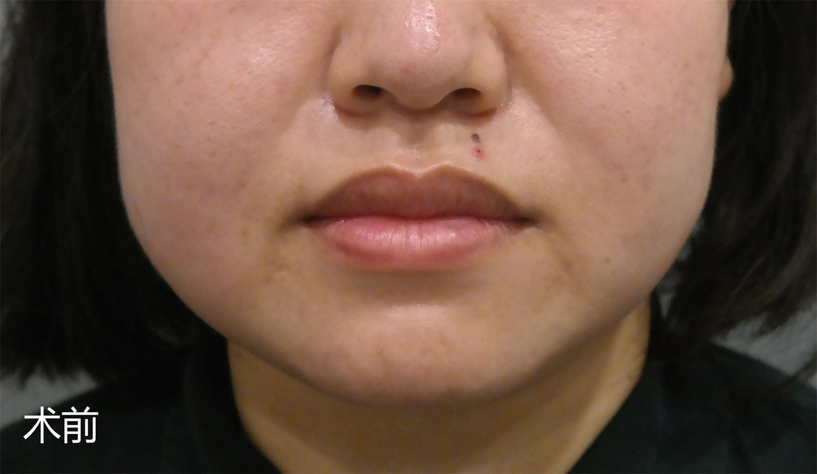 下颌缘松弛下垂怎么办？不同起因不同的治疗方案