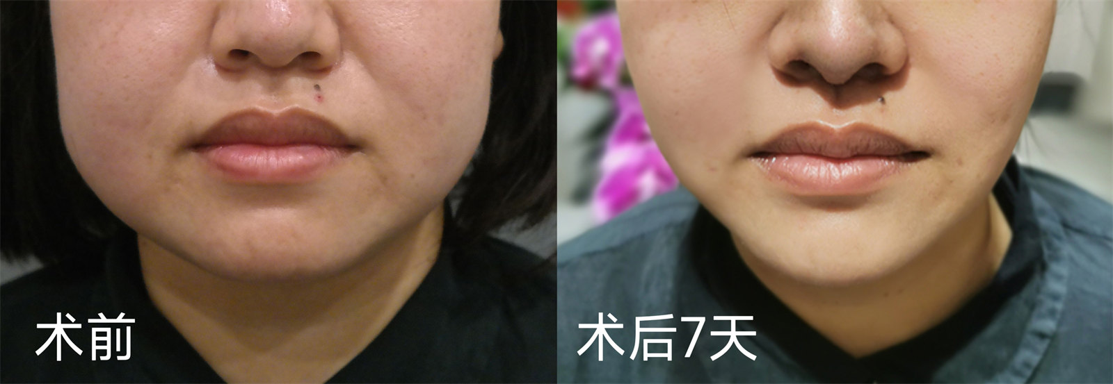 下颌缘松弛下垂怎么办？不同起因不同的治疗方案