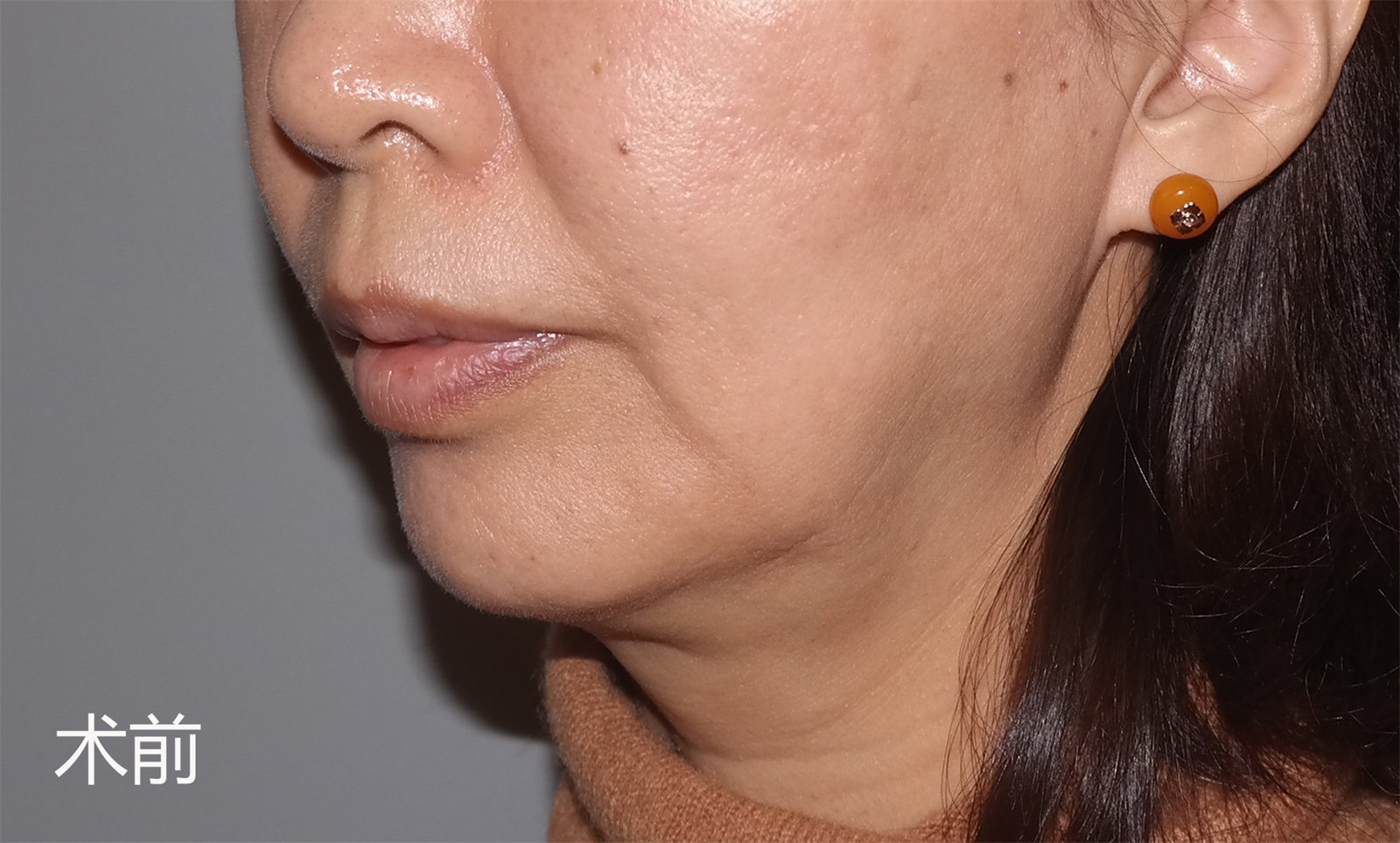 下颌缘松弛下垂怎么办？不同起因不同的治疗方案