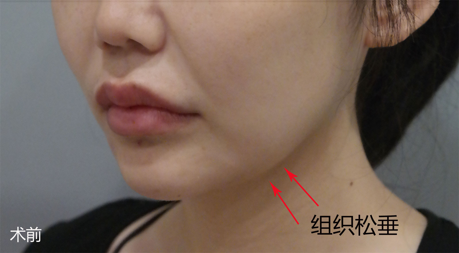 下颌缘松弛下垂怎么办？不同起因不同的治疗方案