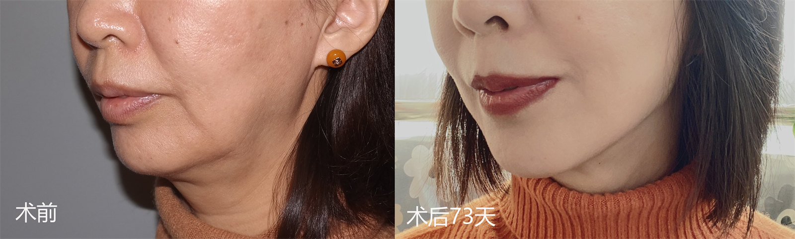 下颌缘松弛下垂怎么办？不同起因不同的治疗方案