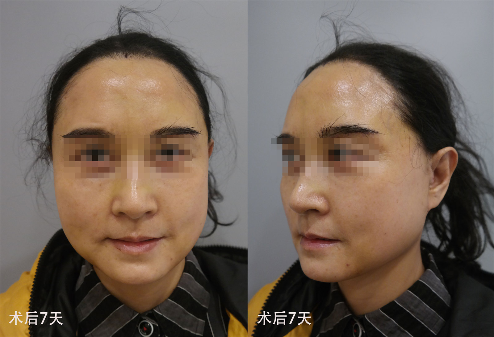 63岁真人拉皮案例分享，术后1个月难掩喜悦之情