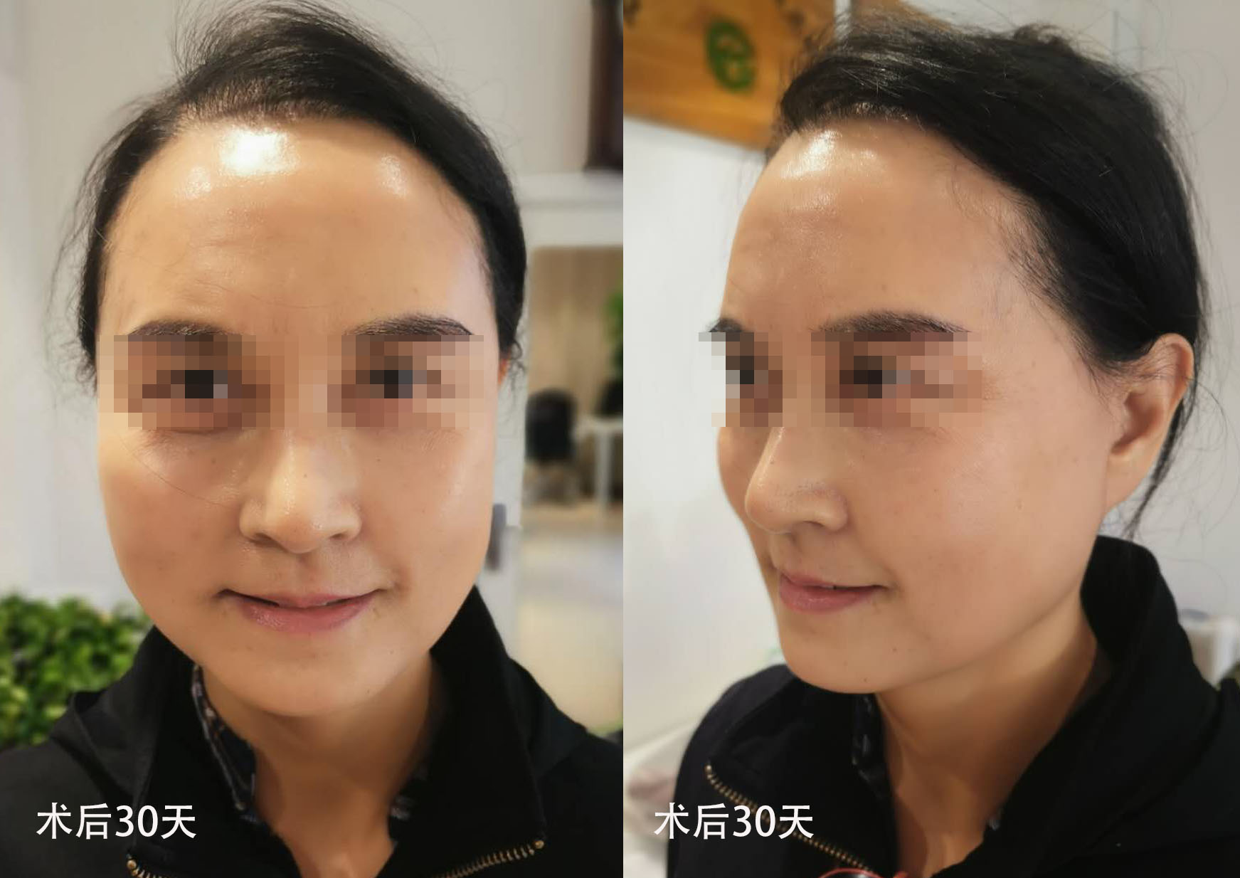 63岁真人拉皮案例分享，术后1个月难掩喜悦之情