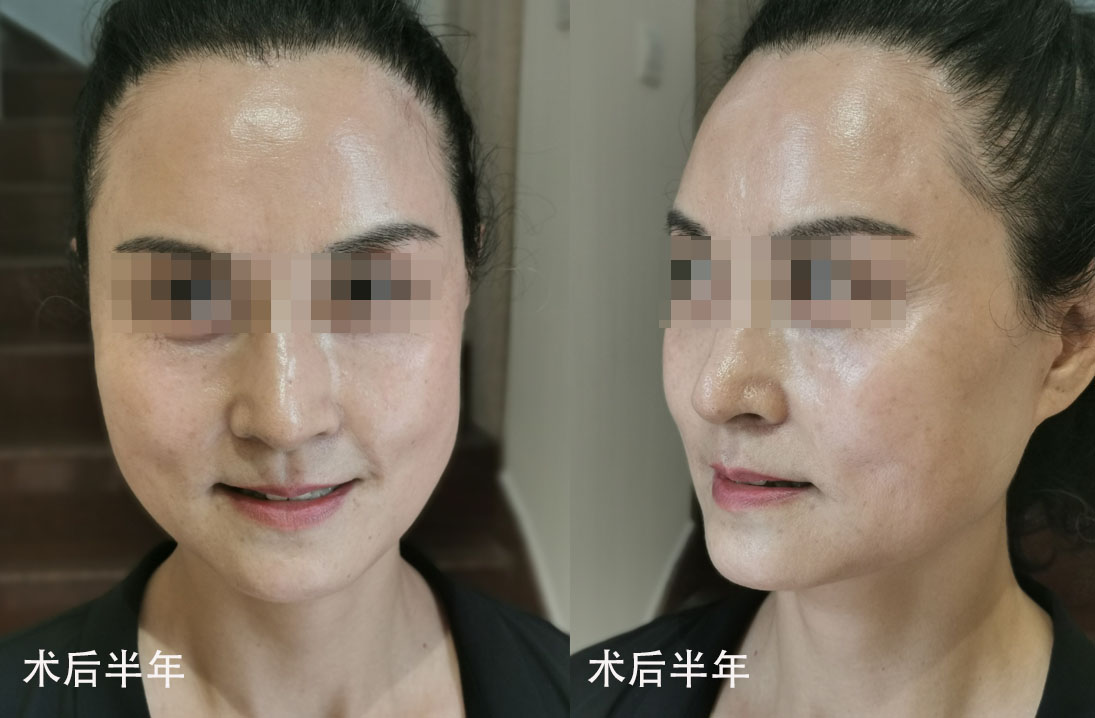 63岁真人拉皮案例分享，术后1个月难掩喜悦之情