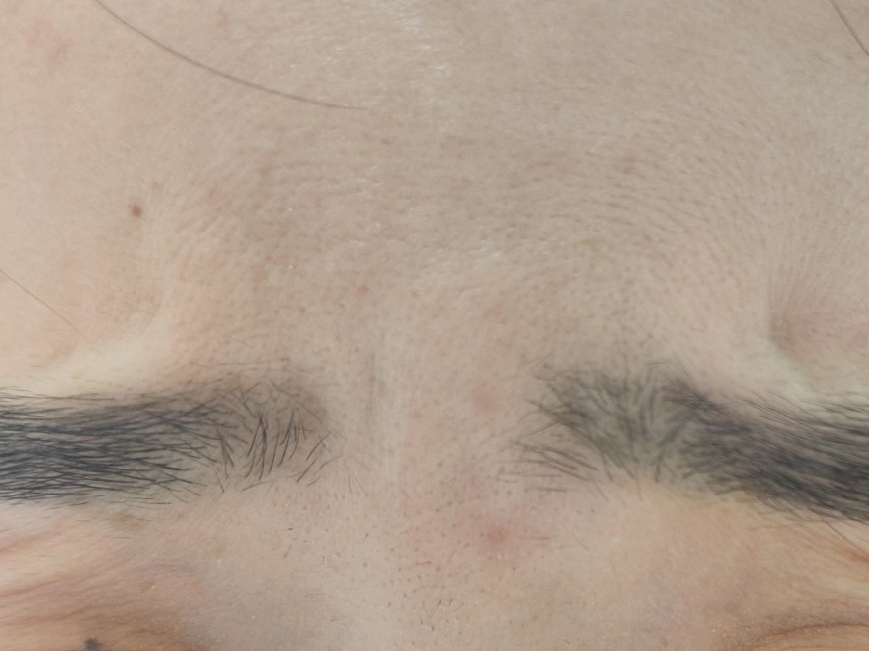 3种川字纹形态，不同的治疗方法公开