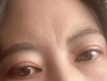 3种川字纹形态，不同的治疗方法公开