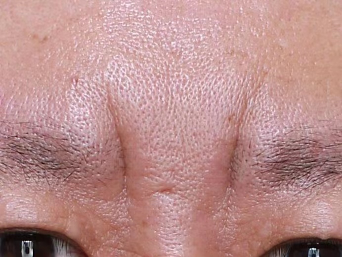 3种川字纹形态，不同的治疗方法公开