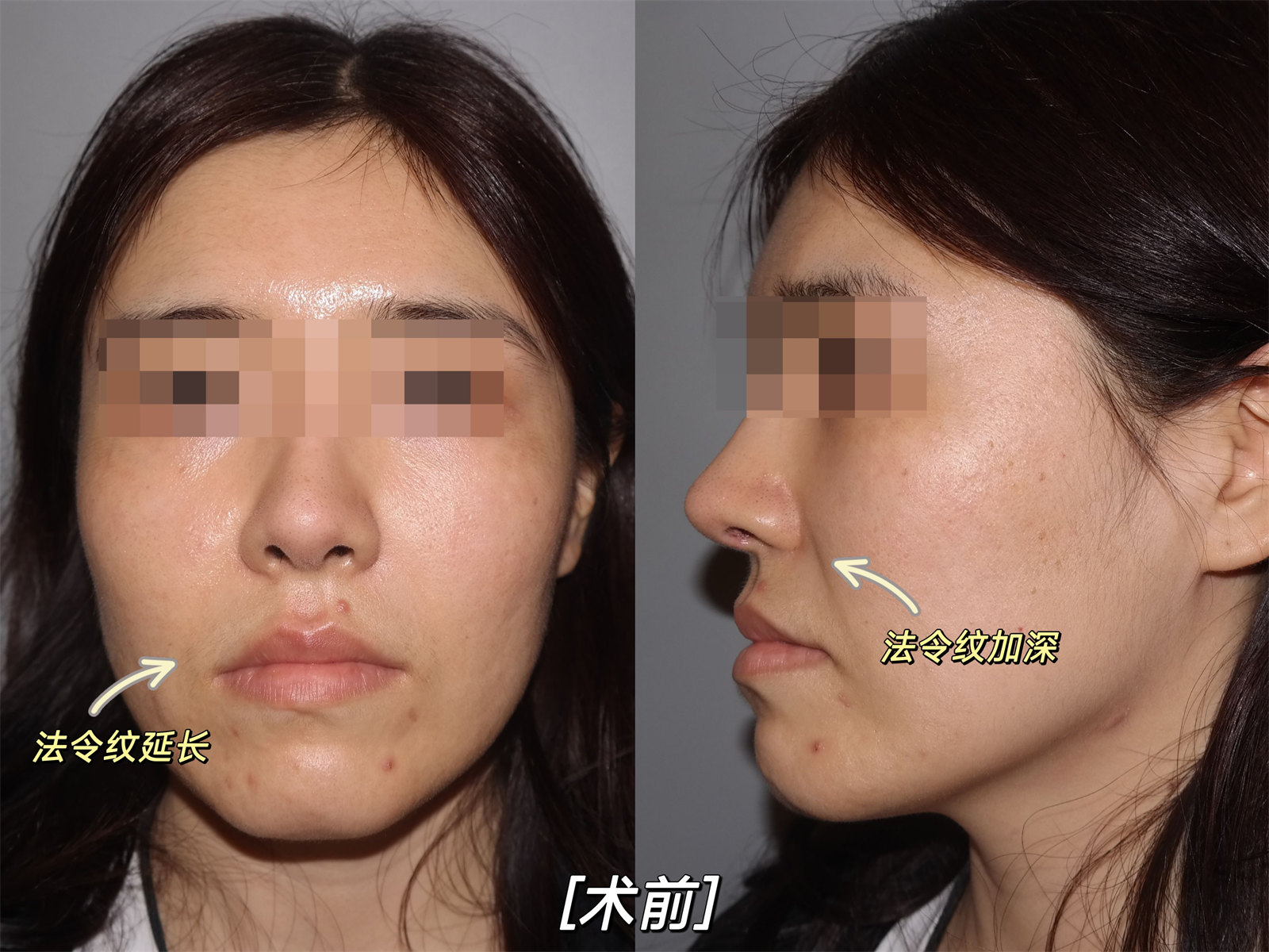 30岁适合做拉皮手术吗？