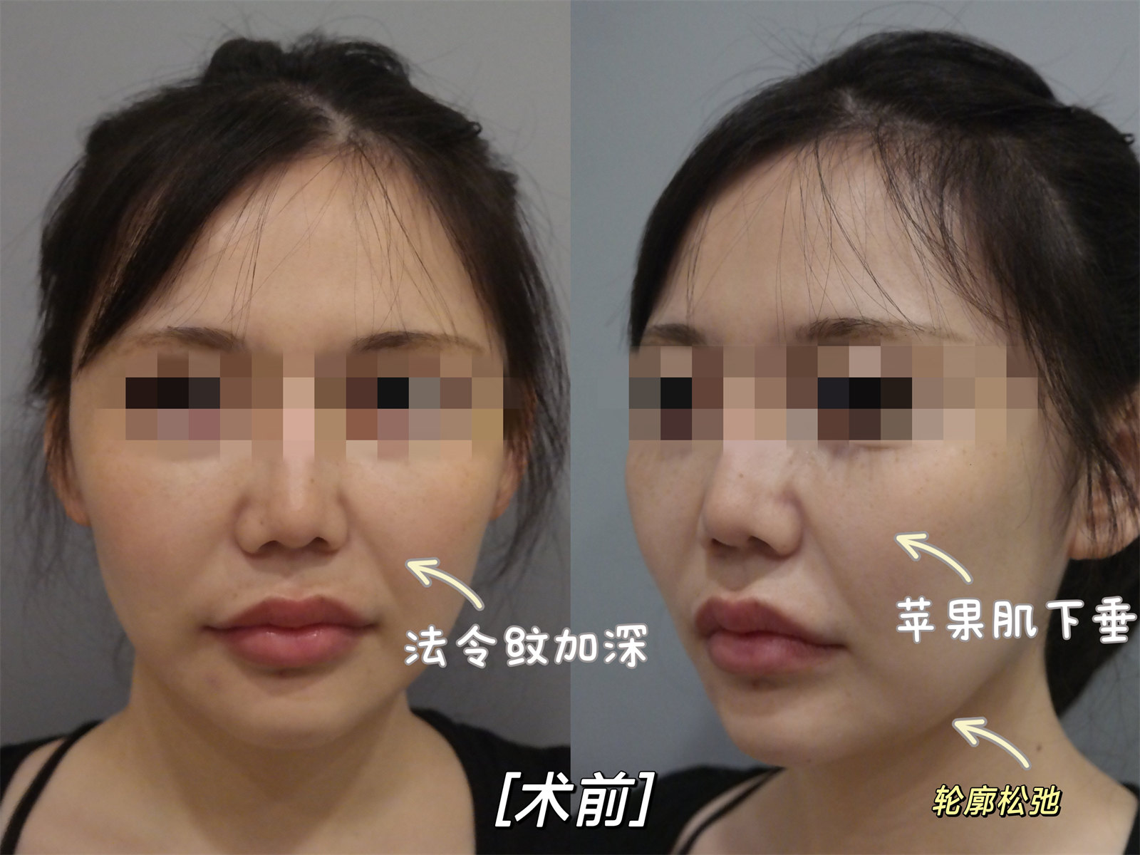 30岁适合做拉皮手术吗？