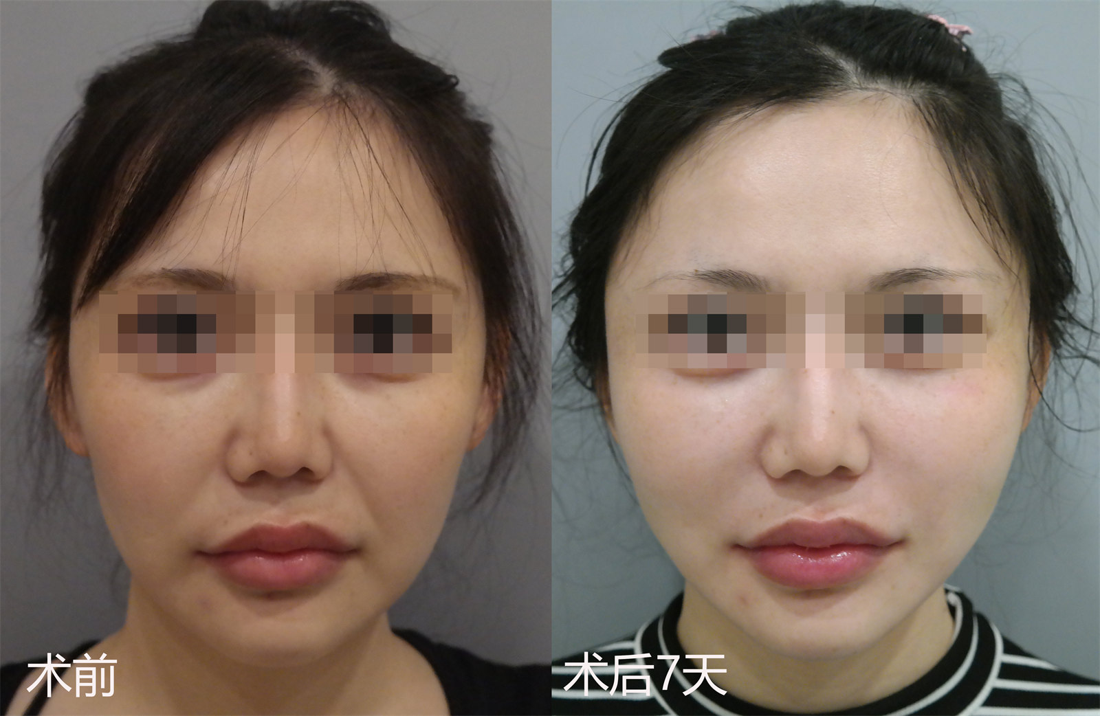 30岁适合做拉皮手术吗？