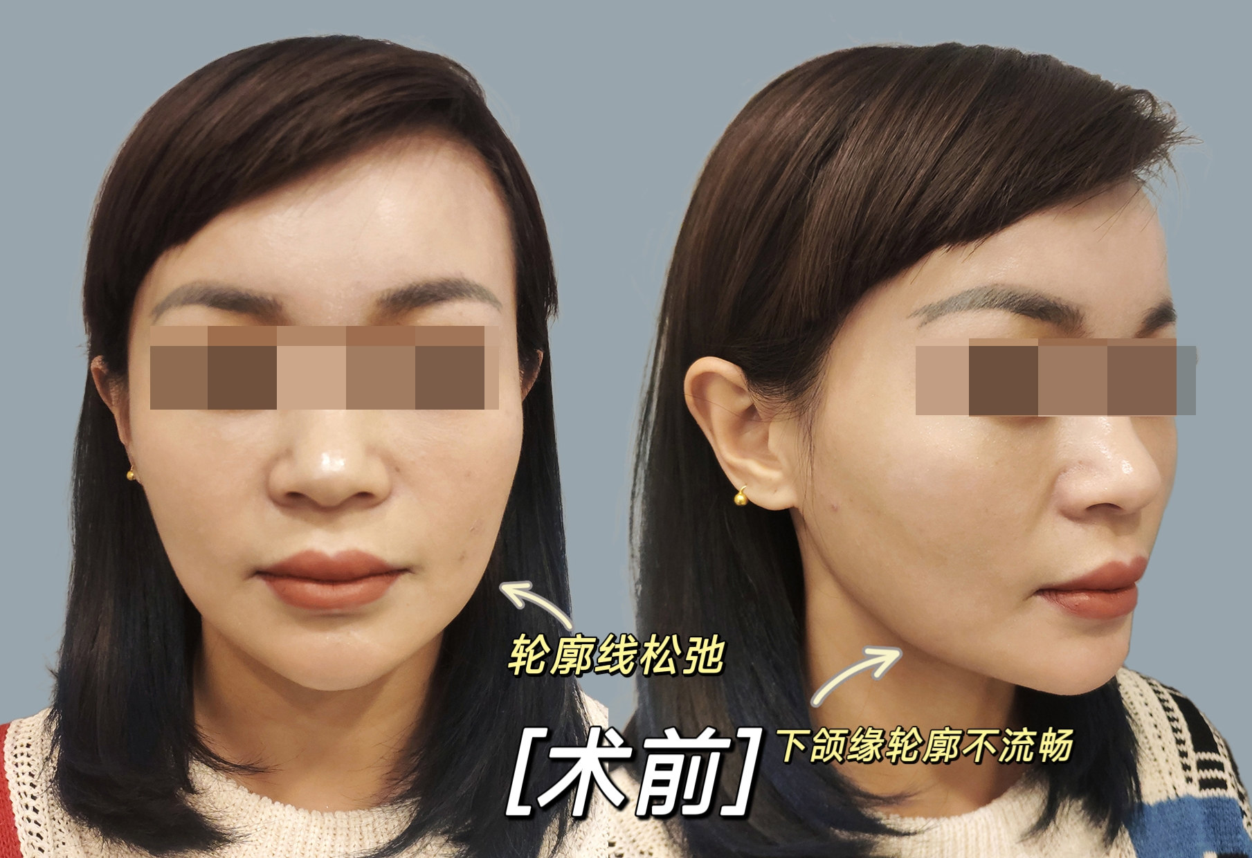 30岁适合做拉皮手术吗？