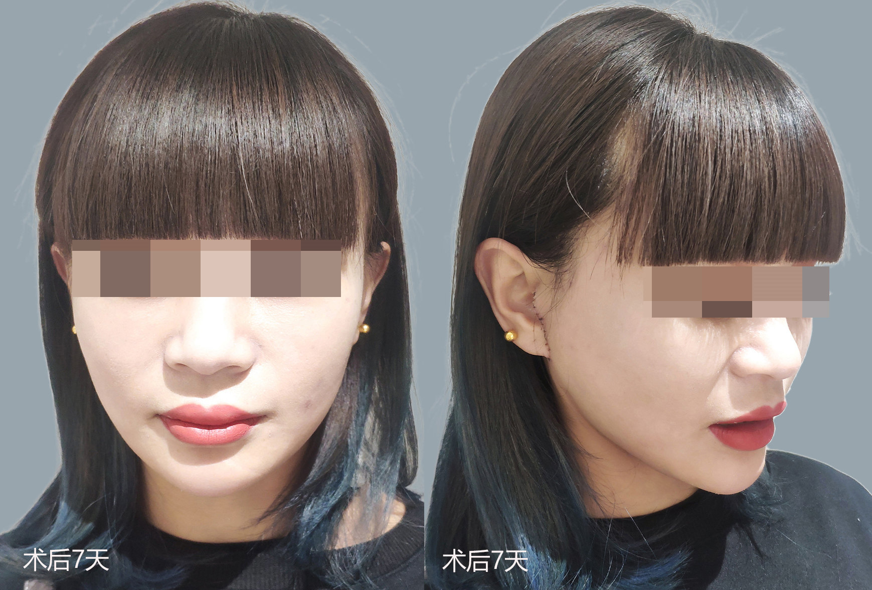 30岁适合做拉皮手术吗？