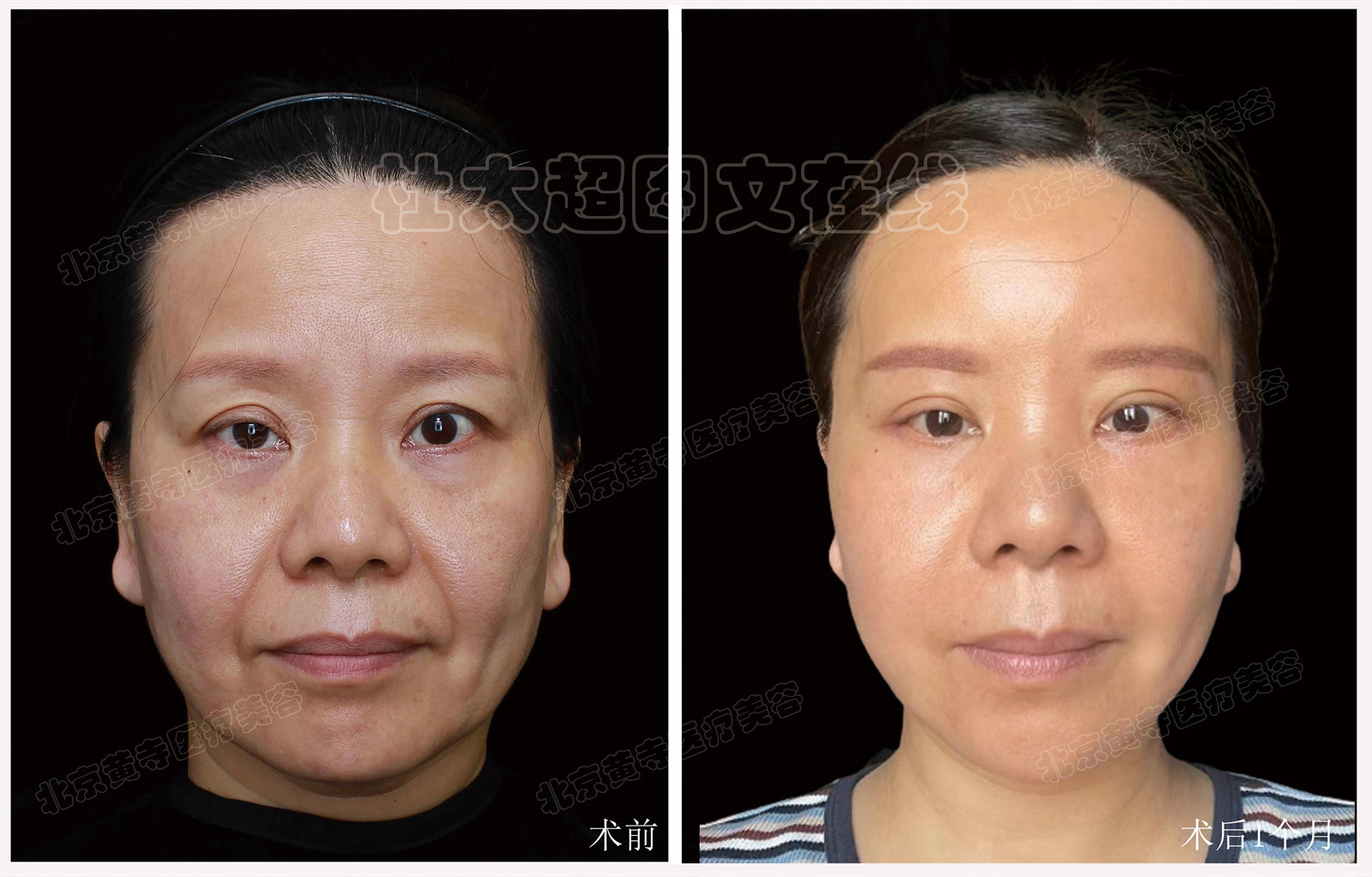 拉皮面部提升术后近期随访1个月