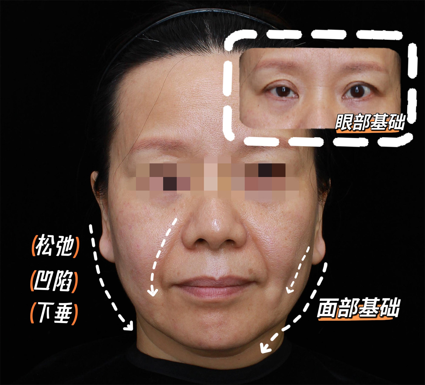 49岁女士拉皮全程记录，术后1个月胶原感满满！