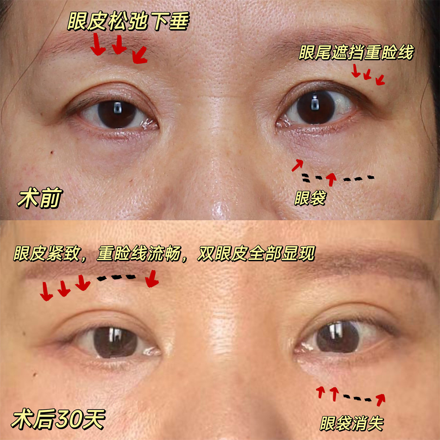 49岁女士拉皮全程记录，术后1个月胶原感满满！