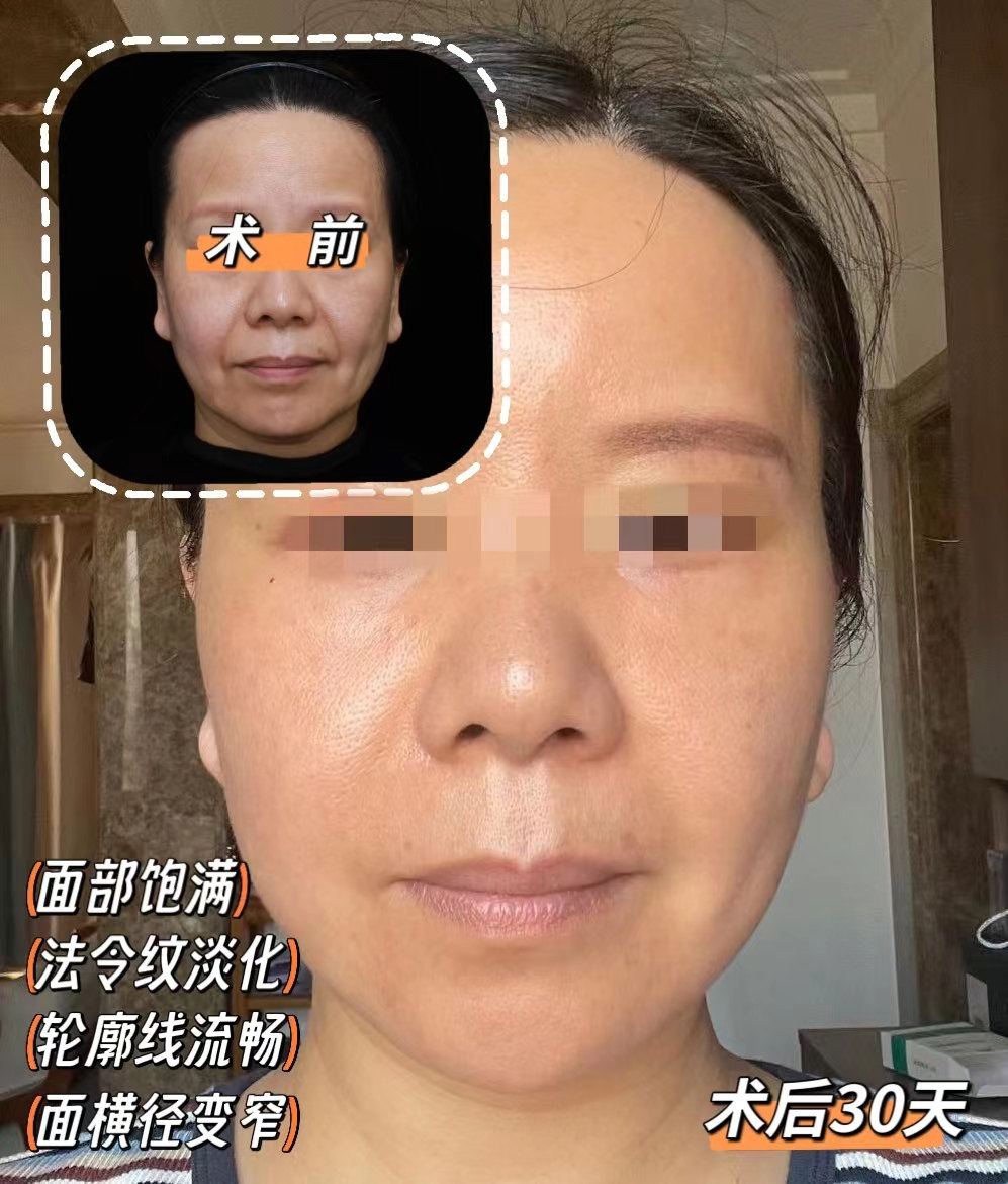 49岁女士拉皮全程记录，术后1个月胶原感满满！
