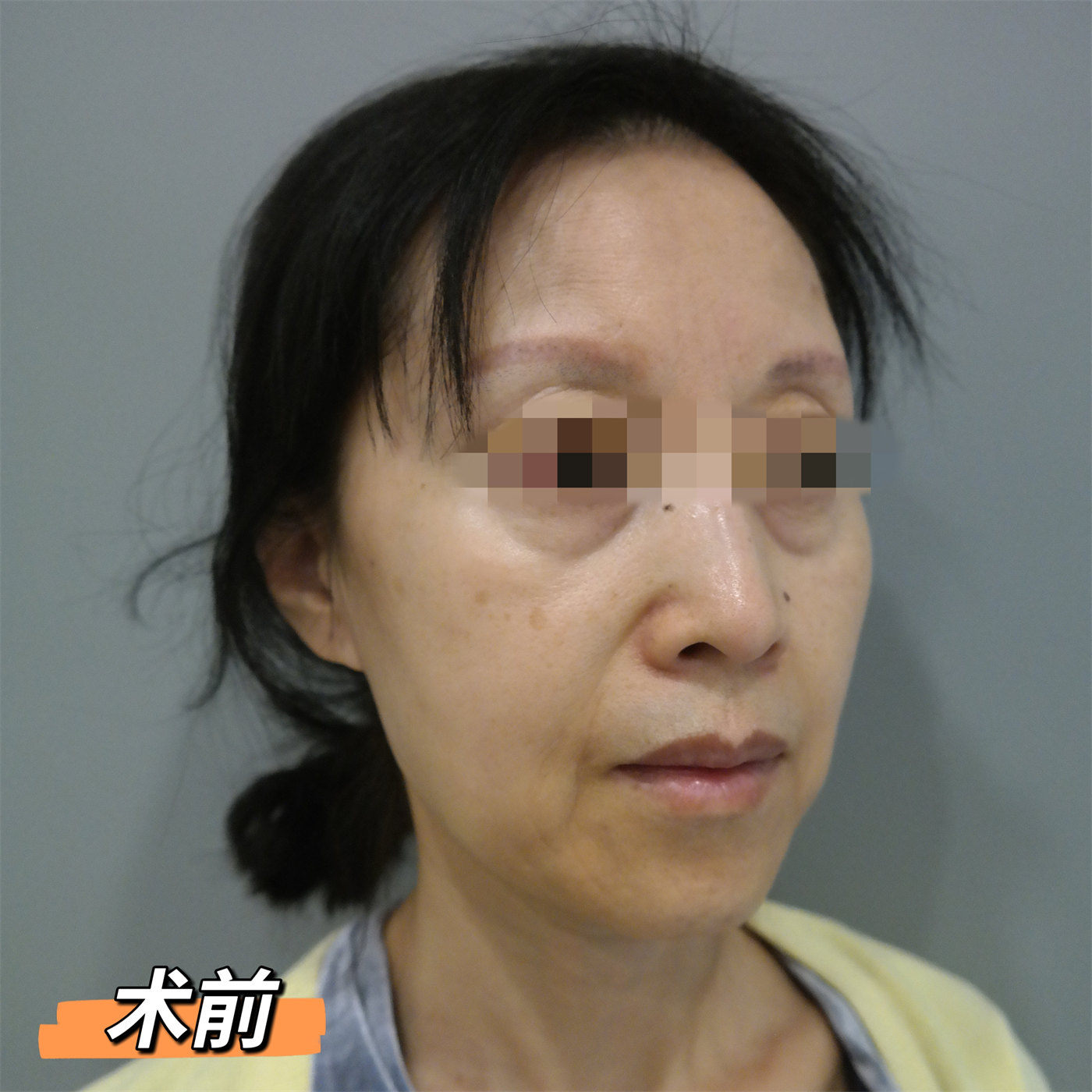 案例日记|53岁艺术院校教师，拉皮术后直接减龄15岁