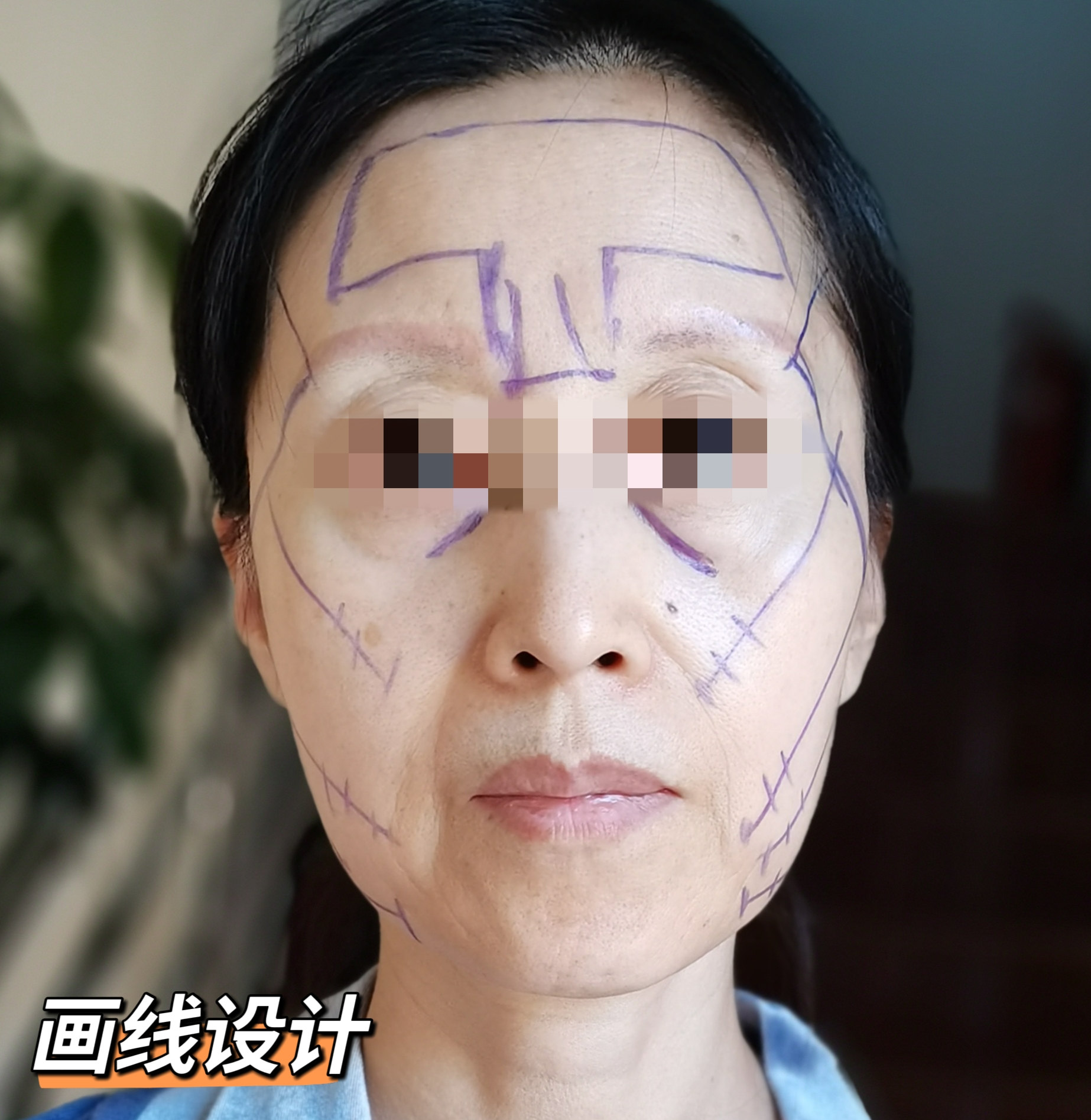 案例日记|53岁艺术院校教师，拉皮术后直接减龄15岁