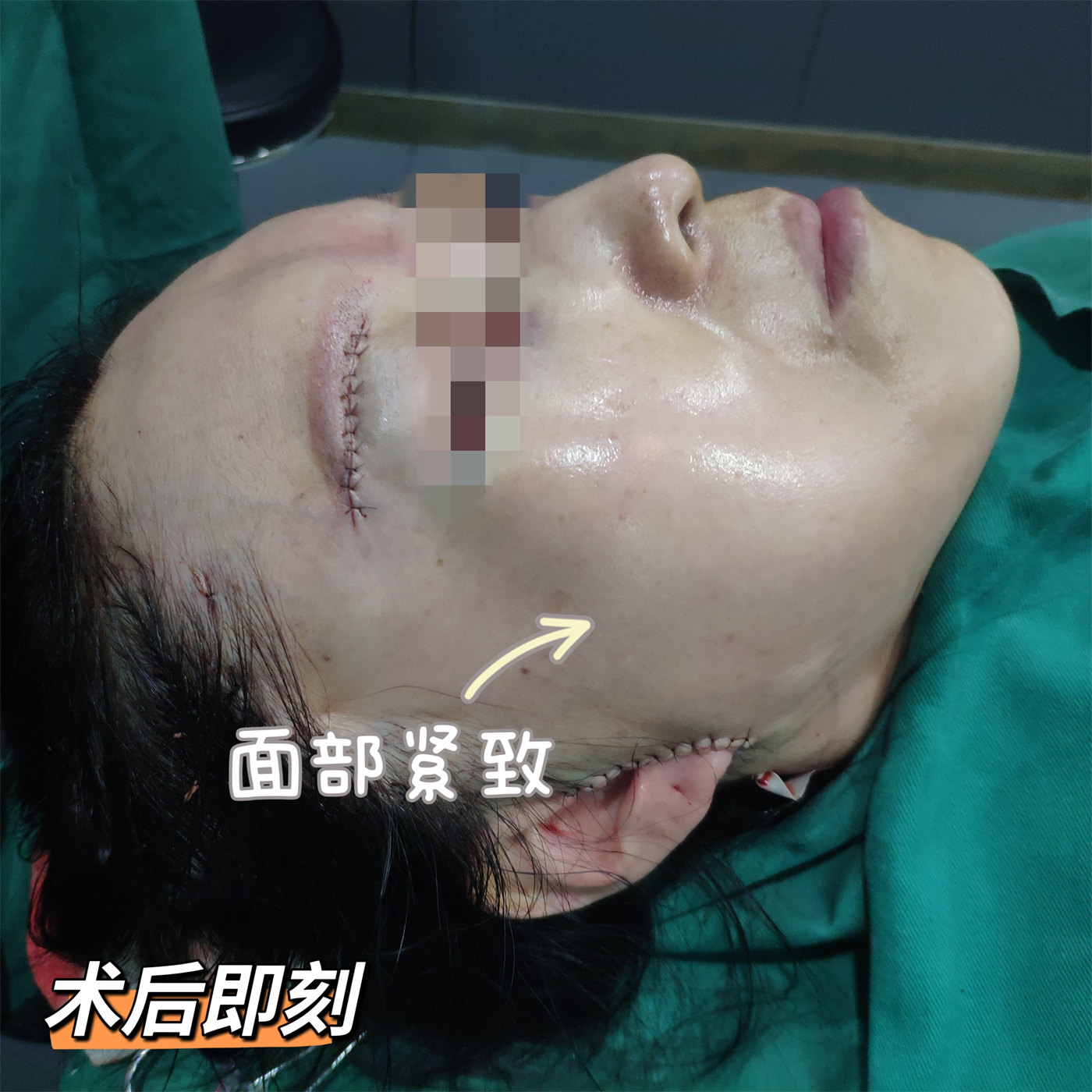 案例日记|53岁艺术院校教师，拉皮术后直接减龄15岁