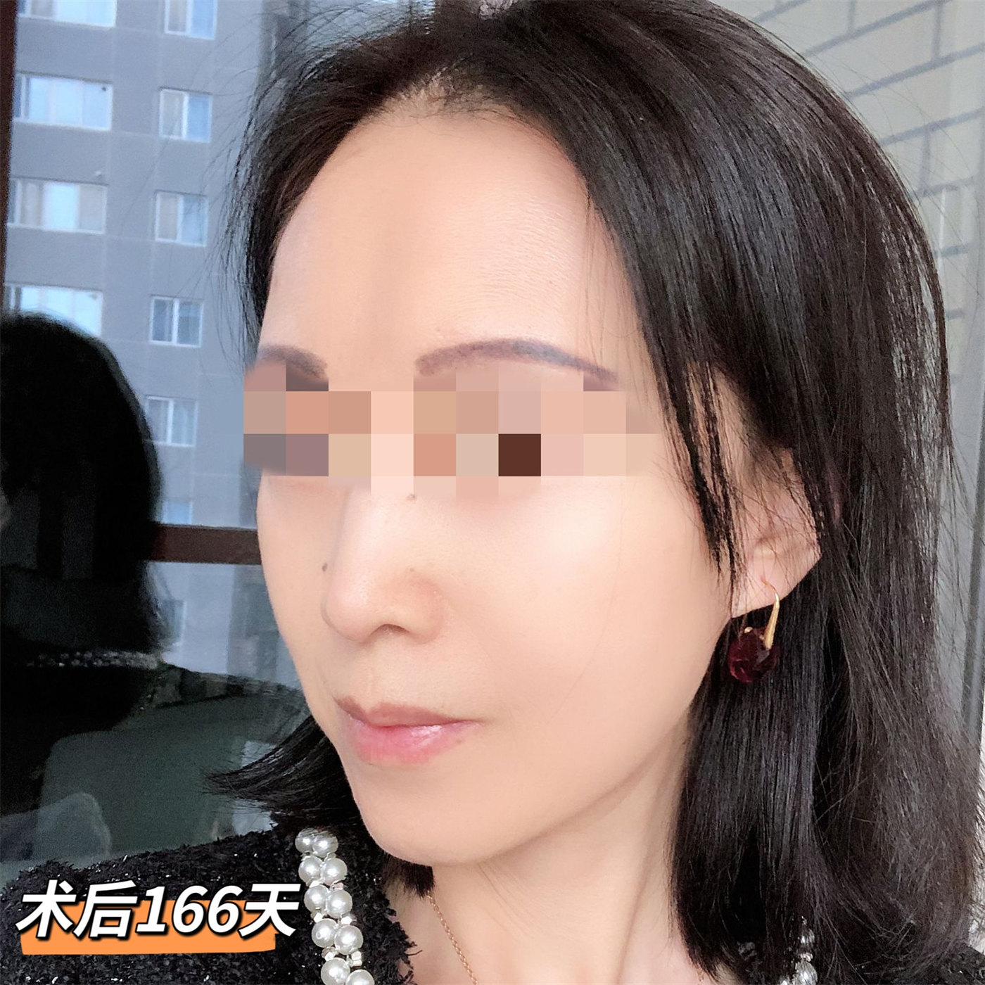 案例日记|53岁艺术院校教师，拉皮术后直接减龄15岁