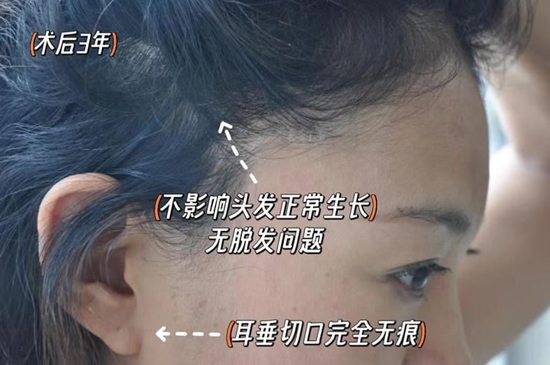 拉皮手术有哪些后遗症? 拉皮手术有哪些后遗症?