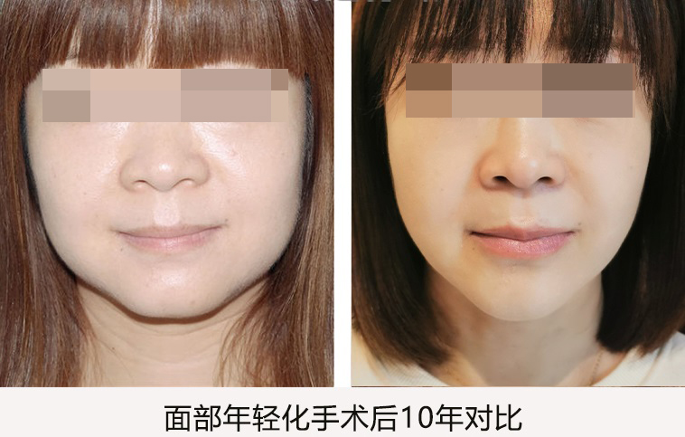 拉皮手术有哪些后遗症? 拉皮手术有哪些后遗症?