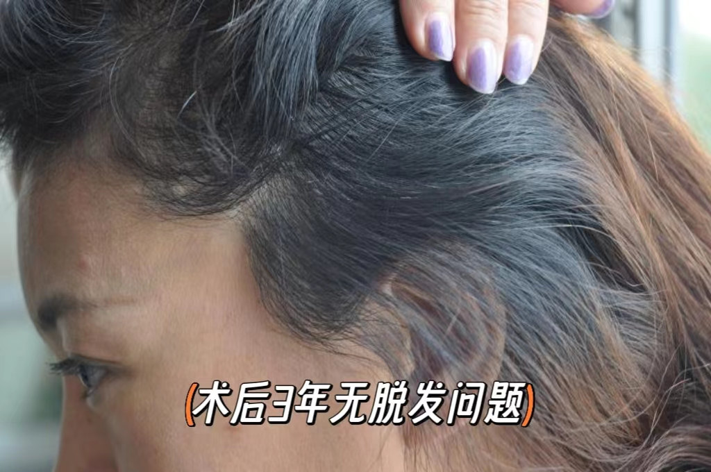 回答你最关心的“拉皮手术”的5大问题，包括价格！