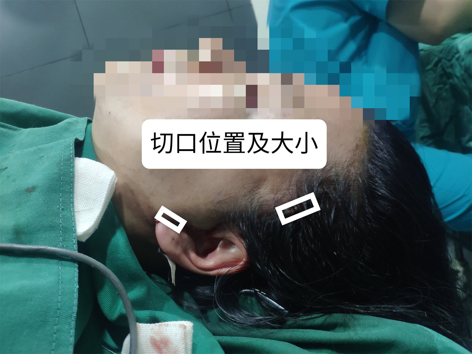 回答你最关心的“拉皮手术”的5大问题，包括价格！