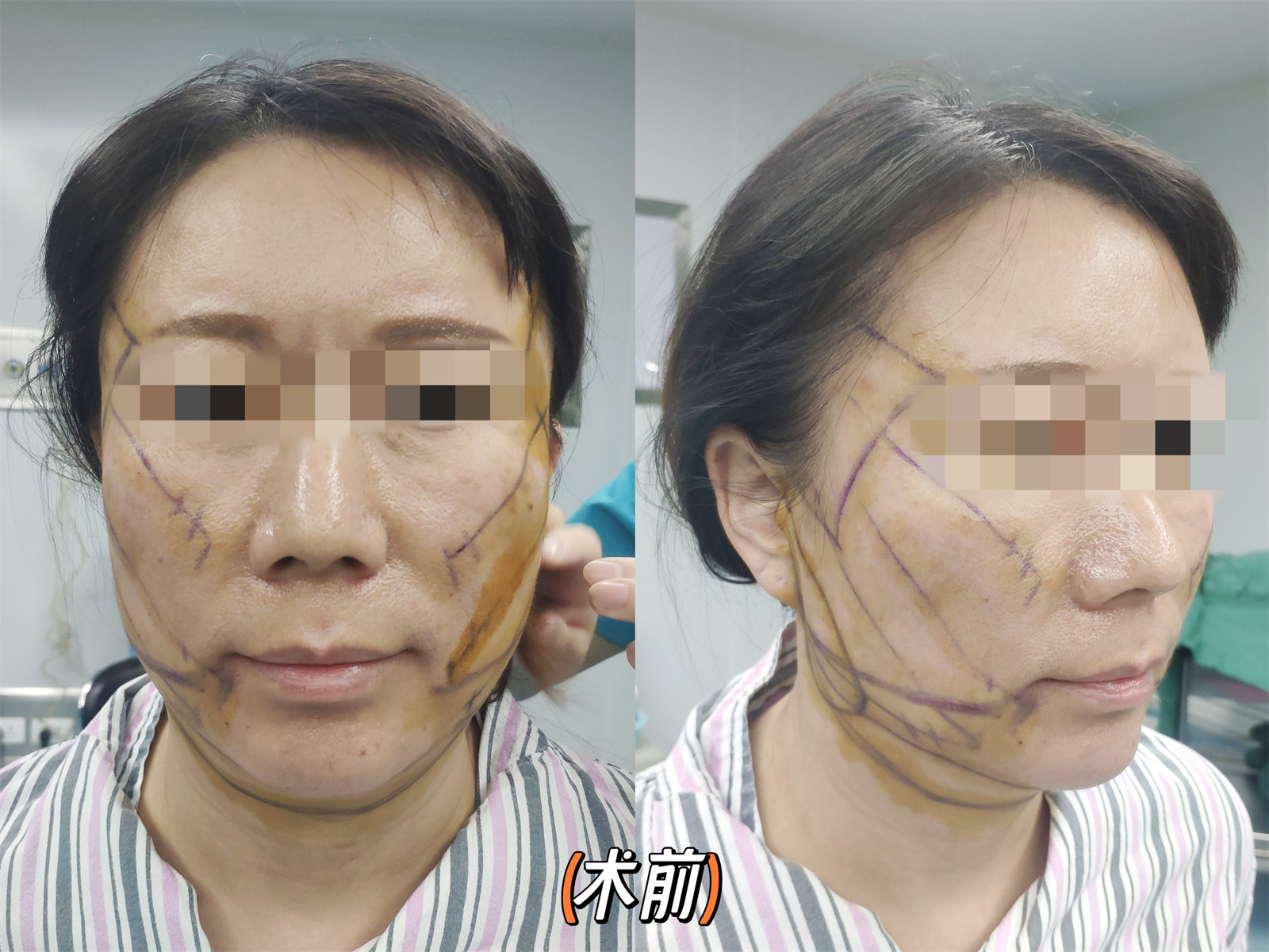 拉皮提升抗衰效果怎么样?两个案例供您参考 拉皮提升抗衰效果怎么样?两个案例供您参考