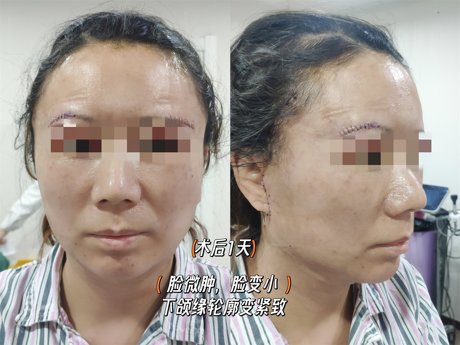 拉皮提升抗衰效果怎么样?两个案例供您参考 拉皮提升抗衰效果怎么样?两个案例供您参考