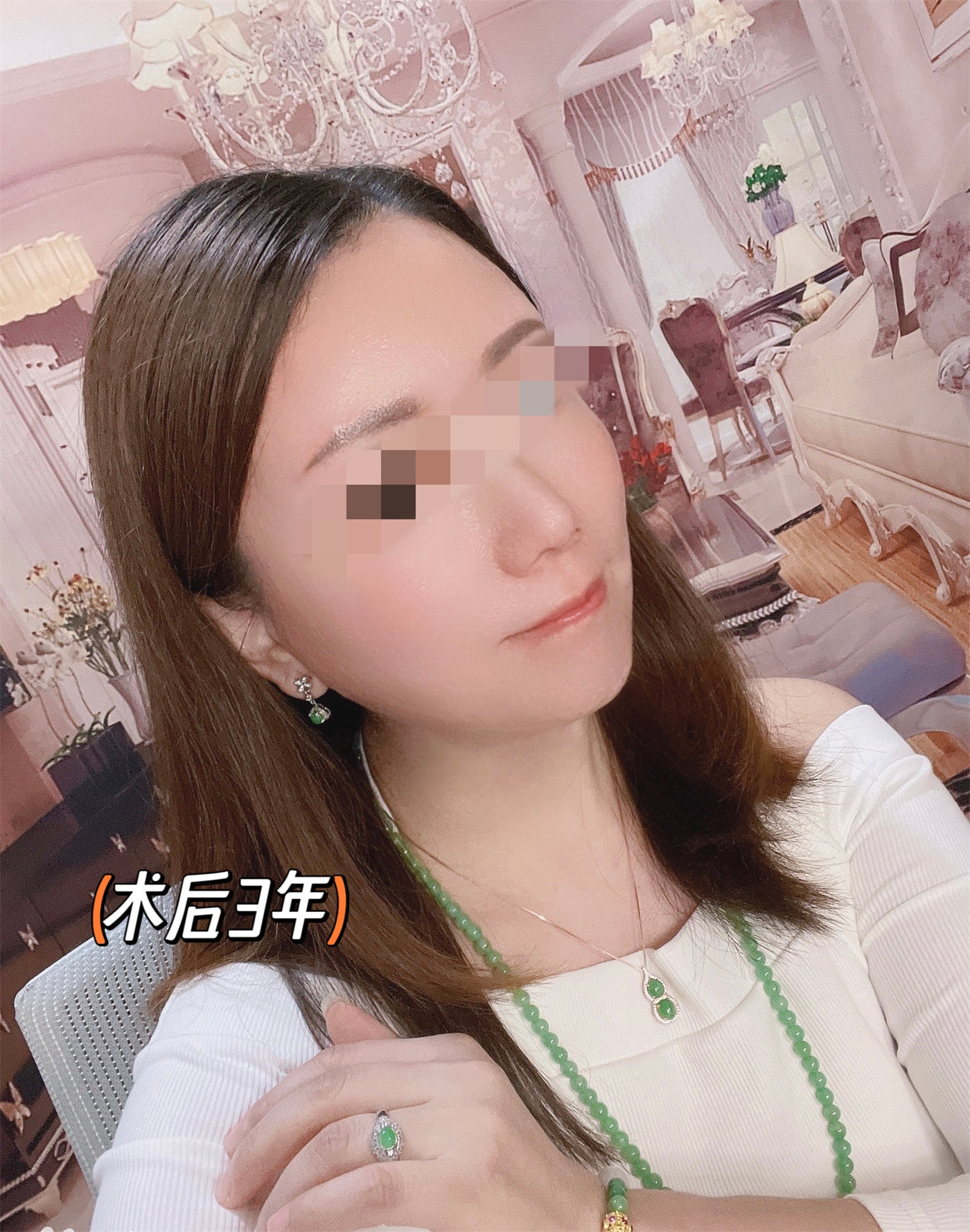 拉皮提升抗衰效果怎么样?两个案例供您参考 拉皮提升抗衰效果怎么样?两个案例供您参考