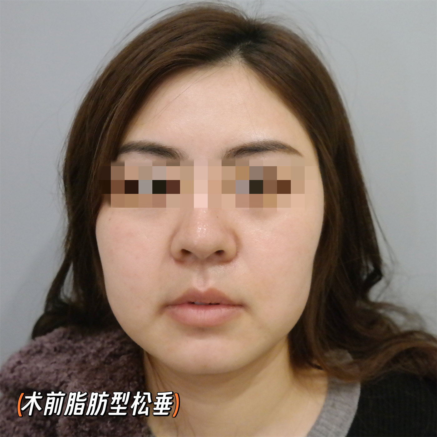 拉皮提升抗衰效果怎么样?两个案例供您参考 拉皮提升抗衰效果怎么样?两个案例供您参考