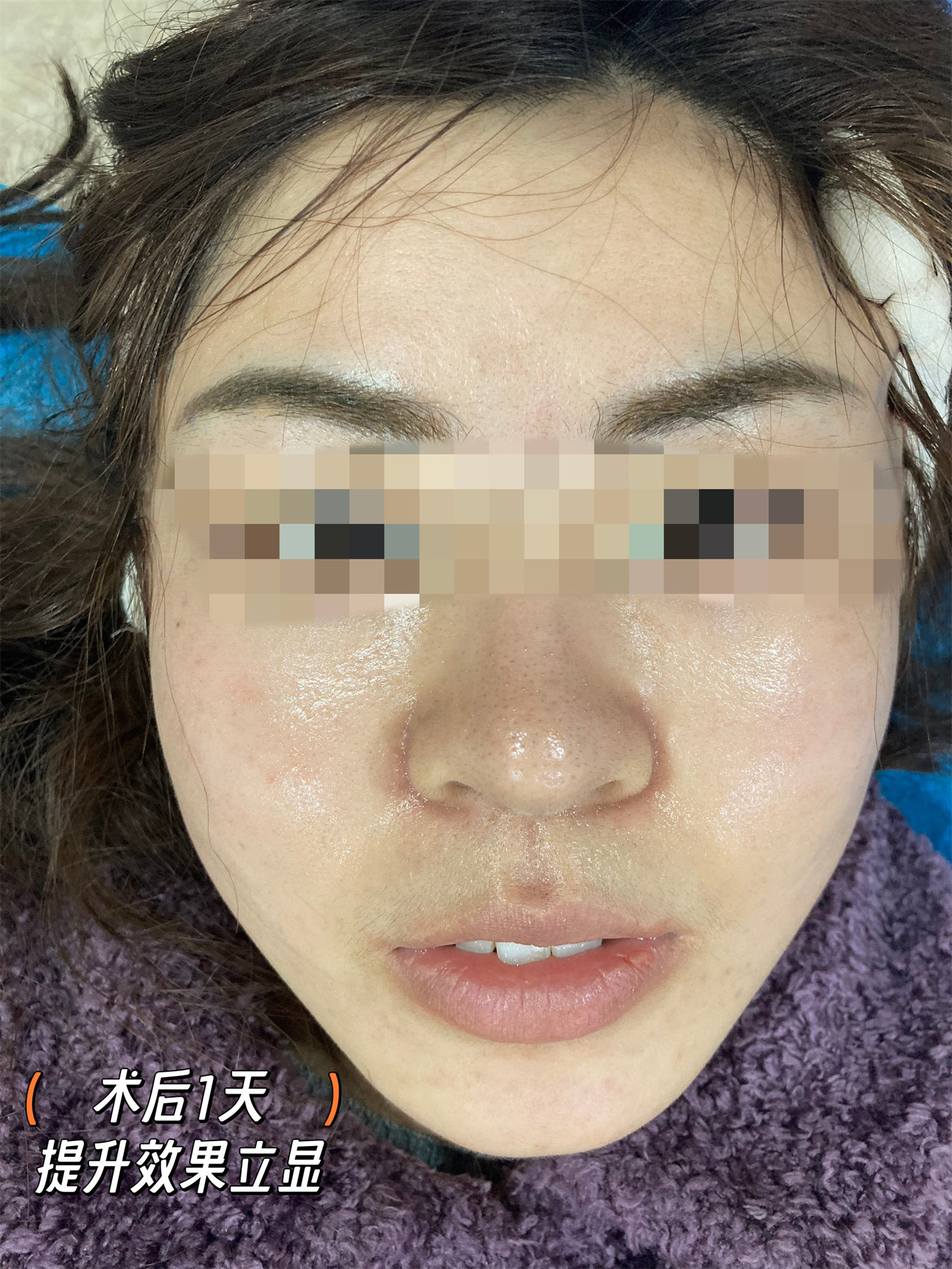 拉皮提升抗衰效果怎么样?两个案例供您参考 拉皮提升抗衰效果怎么样?两个案例供您参考