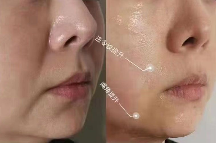 这种类型的法令纹拉皮手术更有效!