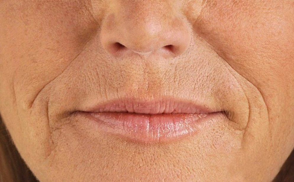 法令纹深，填充和拉皮手术哪个更有效？