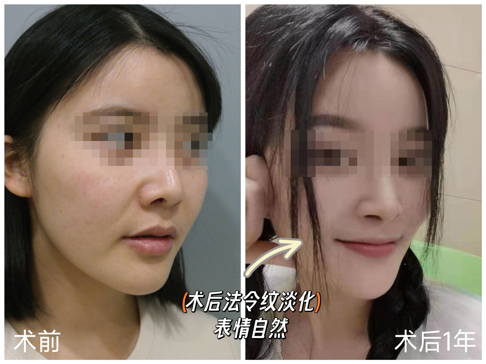 法令纹深，填充和拉皮手术哪个更有效？