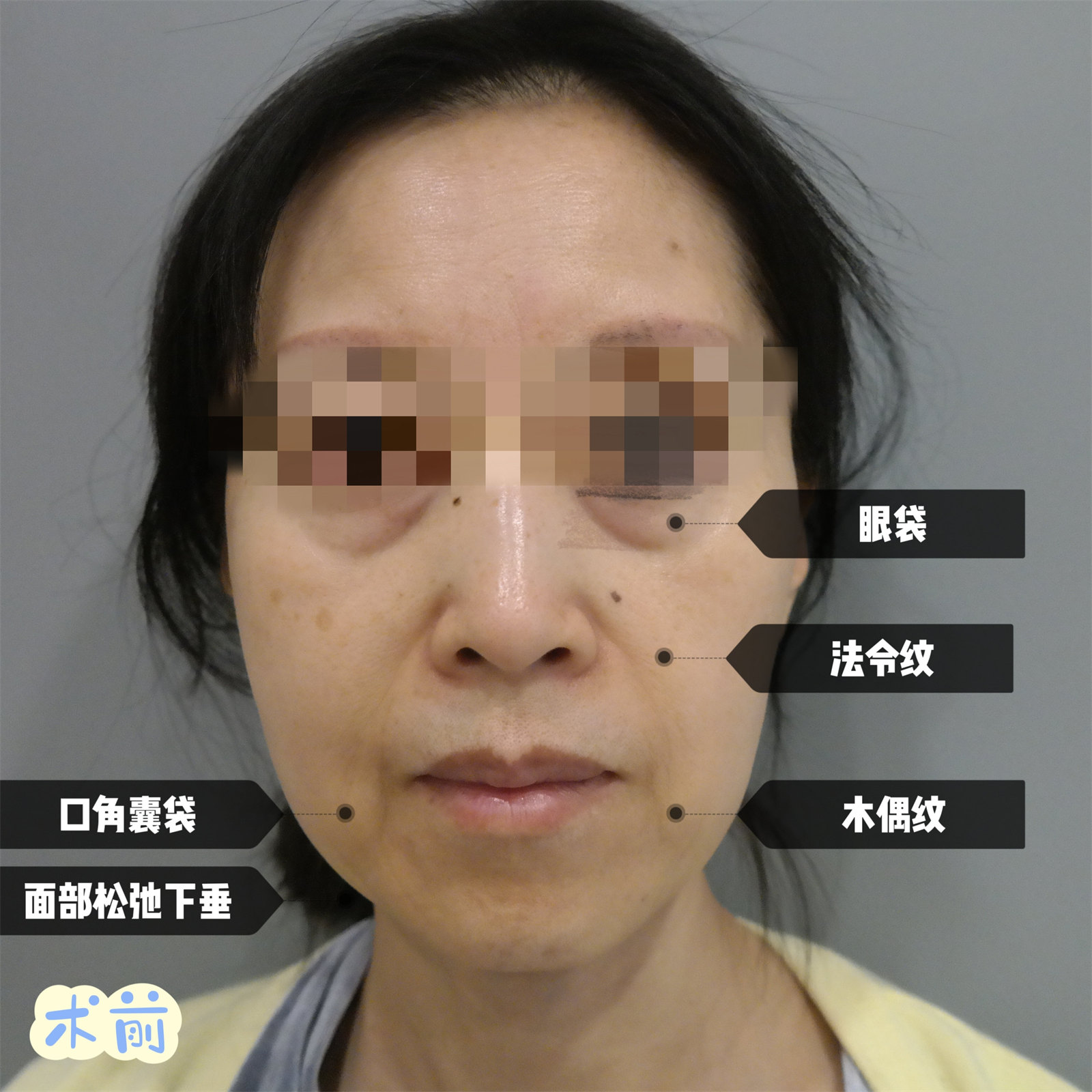 拉皮手术和去眼袋一起做，术后年轻10岁有余！