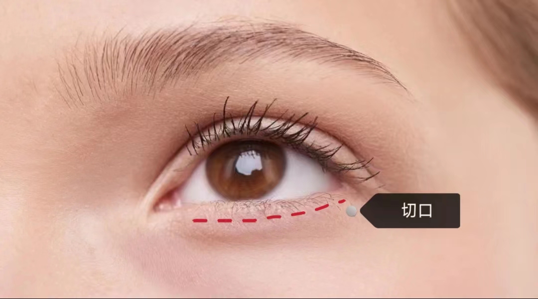 拉皮手术和去眼袋一起做,术后年轻10岁有余! 拉皮手术和去眼袋一起做,术后年轻10岁有余!