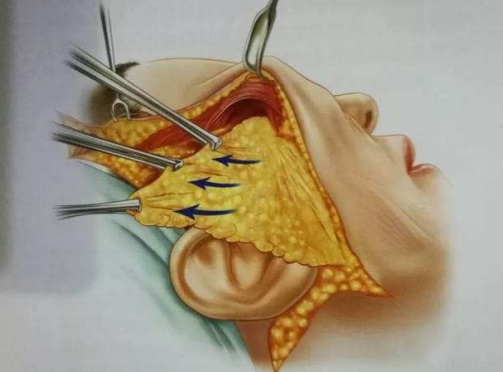 总被问有没有60岁！不甘心做了拉皮手术，第7天拍照，很惊喜