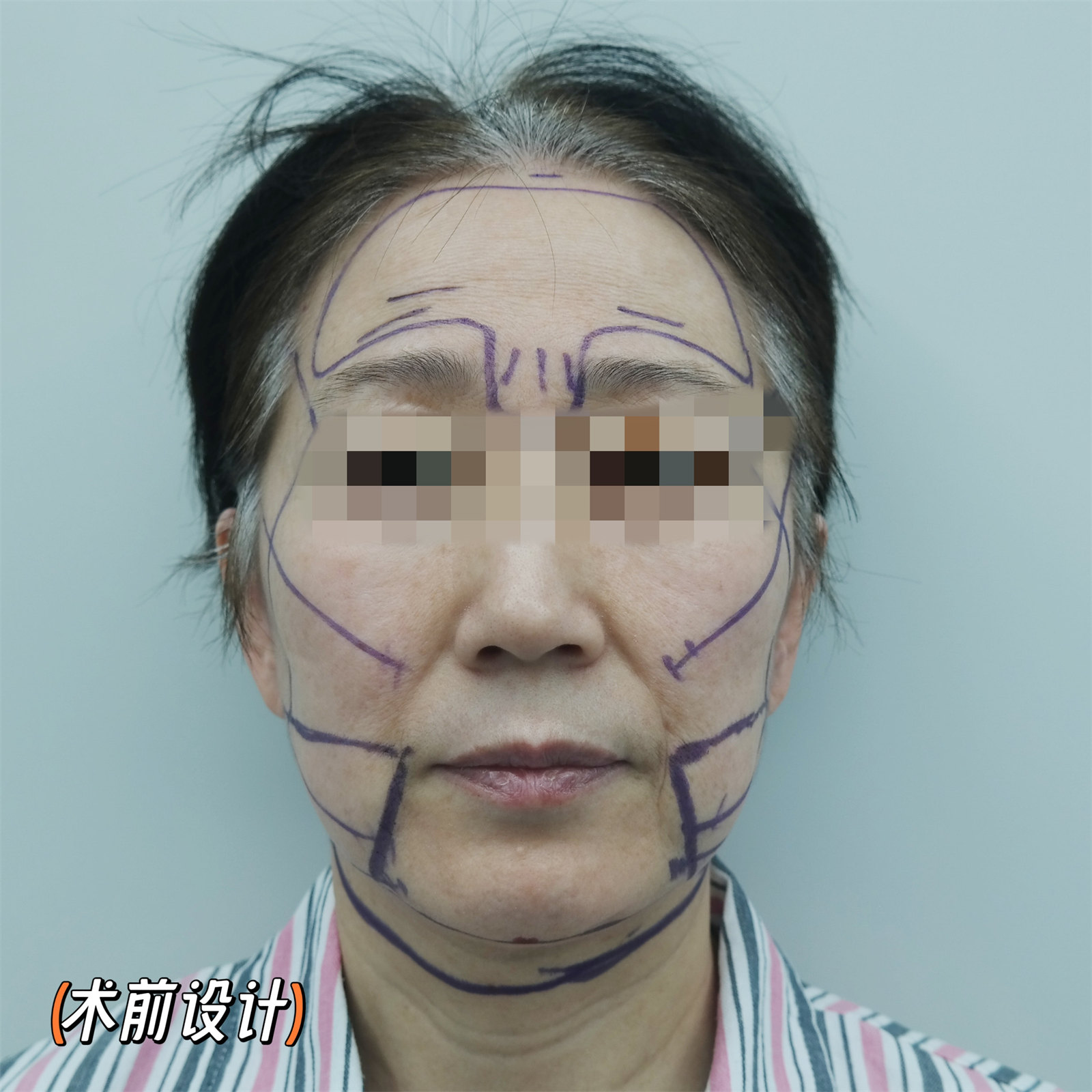 总被问有没有60岁！不甘心做了拉皮手术，第7天拍照，很惊喜