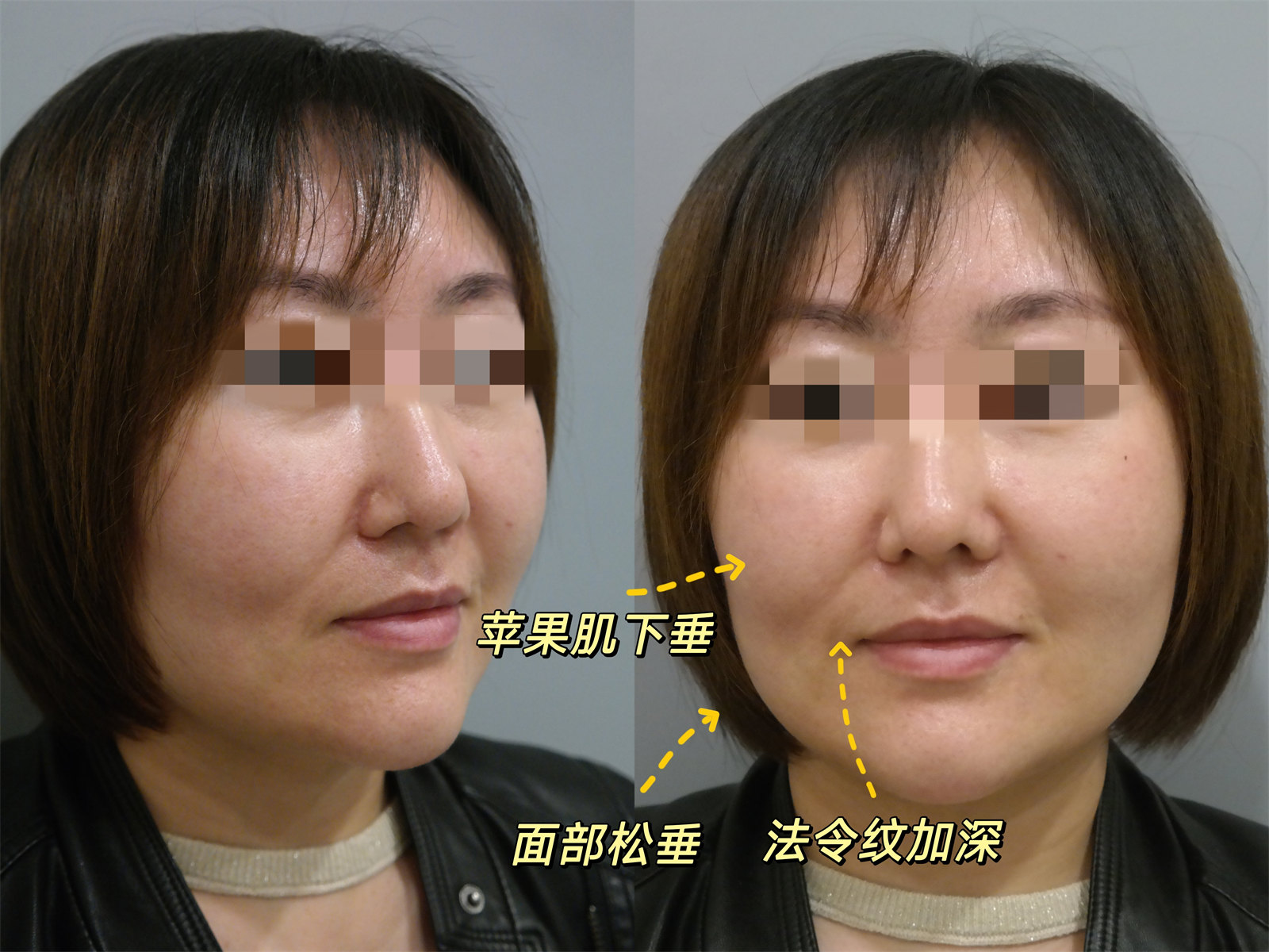 36岁接受不了衰老做了拉皮手术,术后分享真实感受! 36岁接受不了衰老做了拉皮手术,术后分享真实感受!