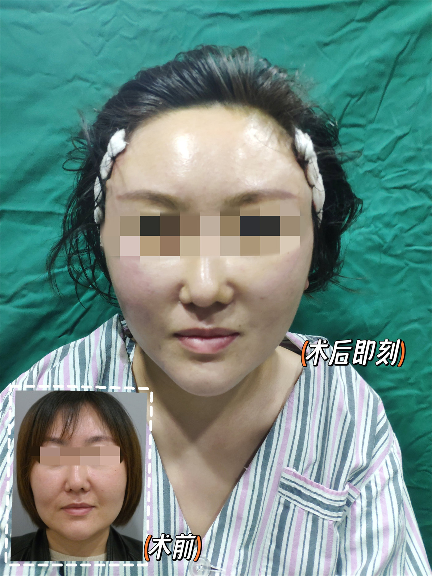 36岁接受不了衰老做了拉皮手术,术后分享真实感受! 36岁接受不了衰老做了拉皮手术,术后分享真实感受!