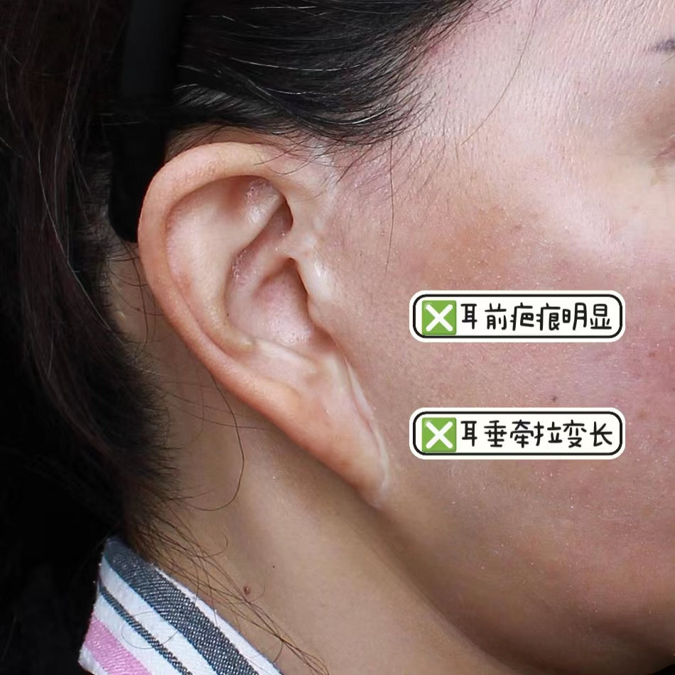 48岁做二次拉皮,亲身经历告诉你如何不走“弯路”! 48岁做二次拉皮,亲身经历告诉你如何不走“弯路”!